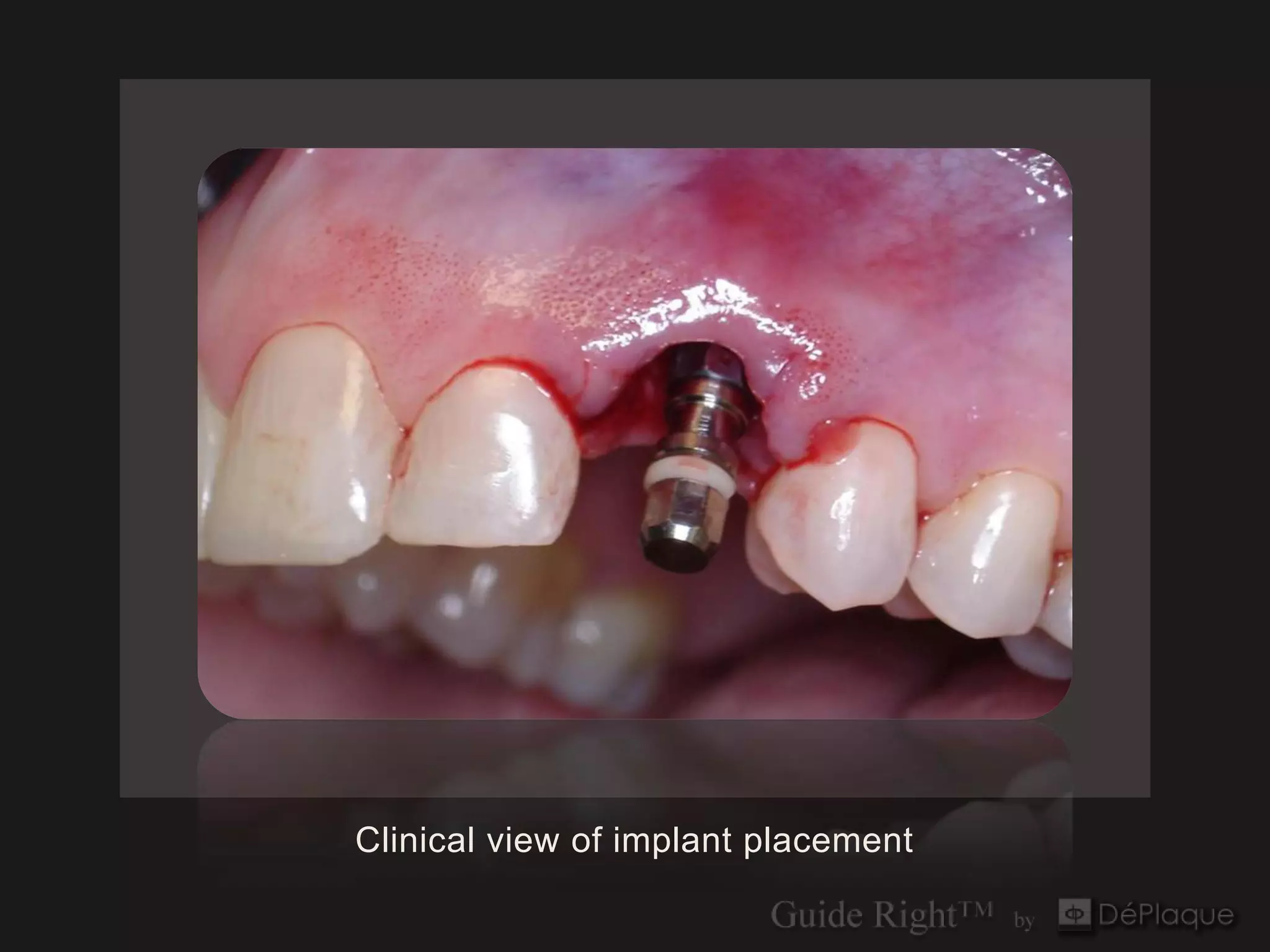 Clinical view of implant placement
 