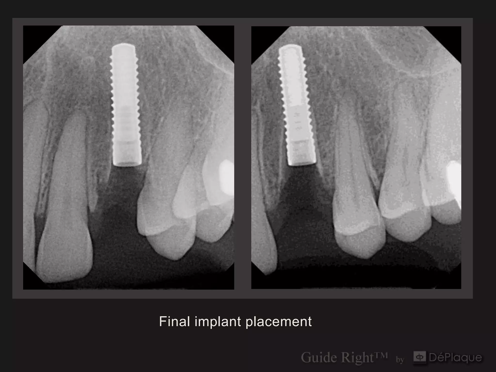 Final implant placement
 