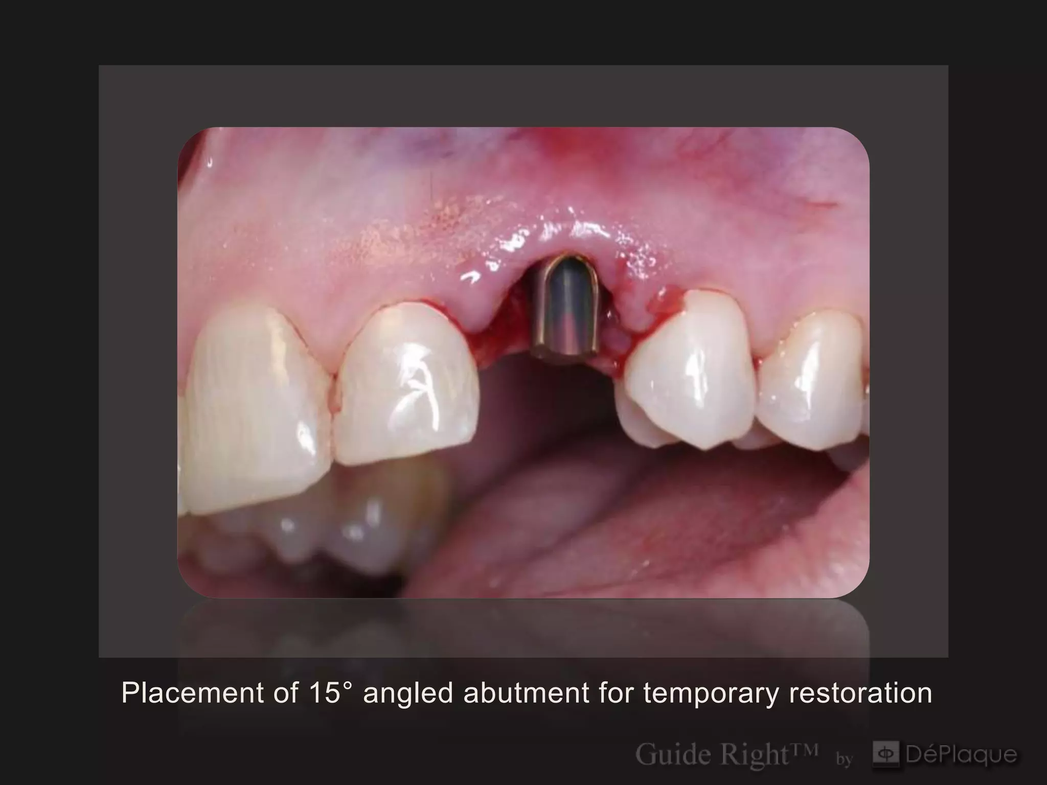 Placement of 15° angled abutment for temporary restoration
 