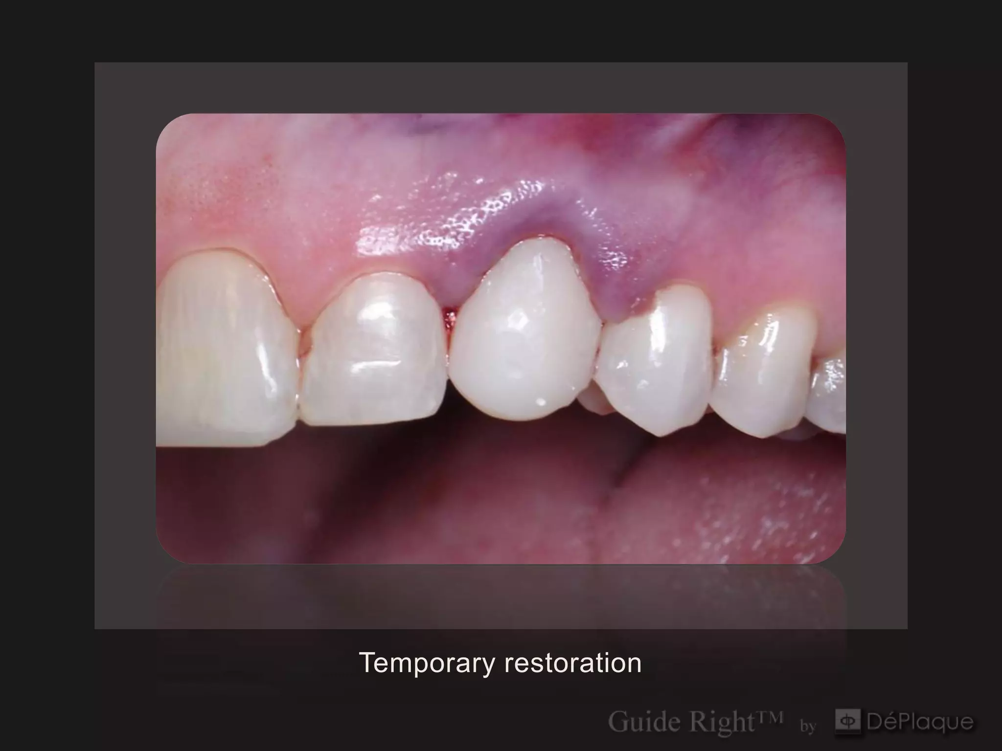 Temporary restoration
 