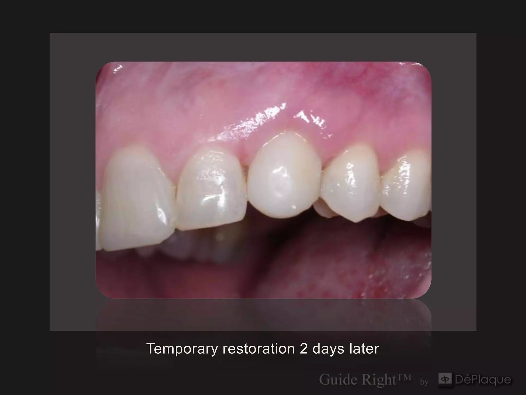 Temporary restoration 2 days later
 