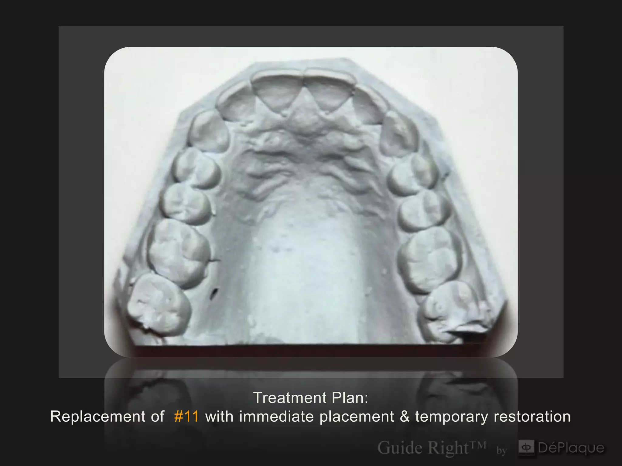 Treatment Plan:
Replacement of #11 with immediate placement & temporary restoration
 