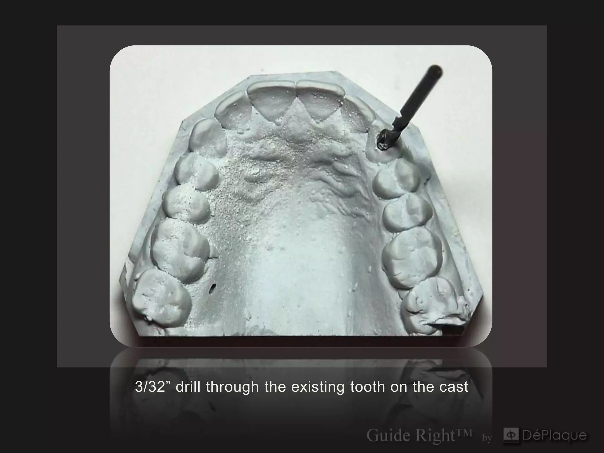 3/32” drill through the existing tooth on the cast
 