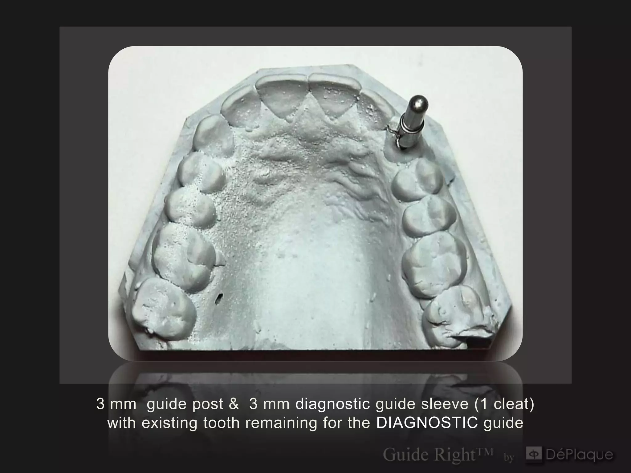 3 mm guide post & 3 mm diagnostic guide sleeve (1 cleat)
 with existing tooth remaining for the DIAGNOSTIC guide
 