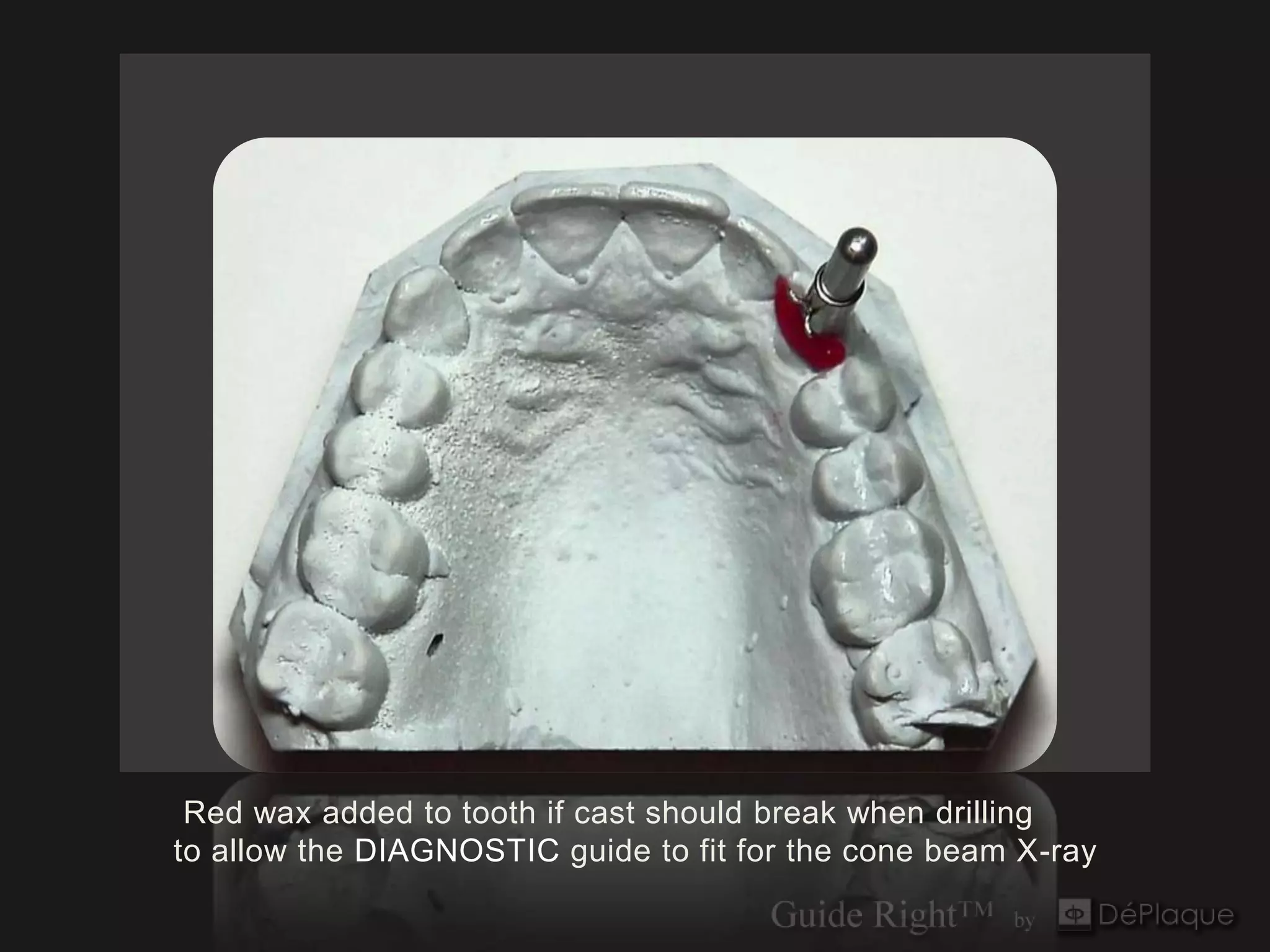 Red wax added to tooth if cast should break when drilling
to allow the DIAGNOSTIC guide to fit for the cone beam X-ray
 