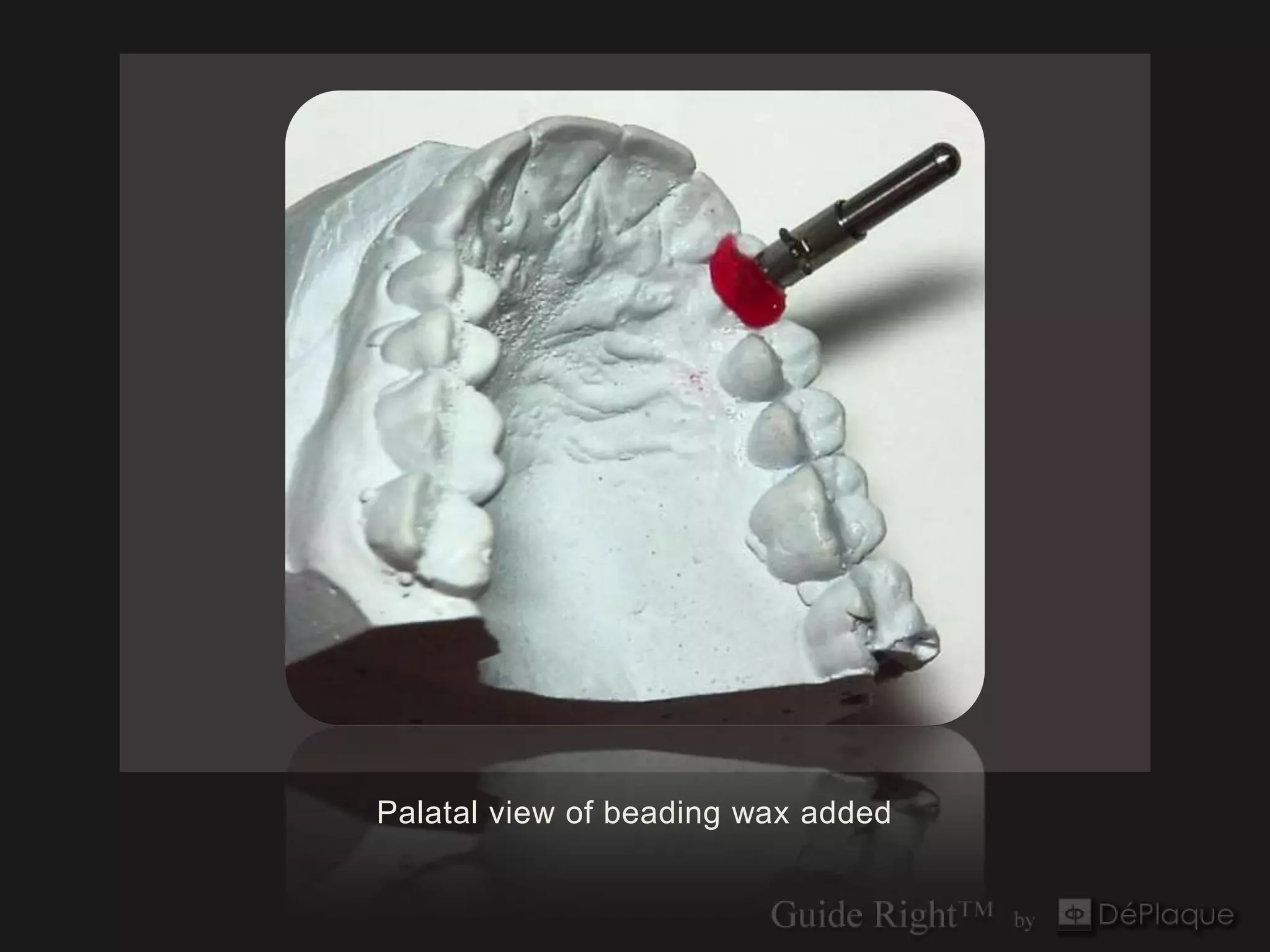 Palatal view of beading wax added
 