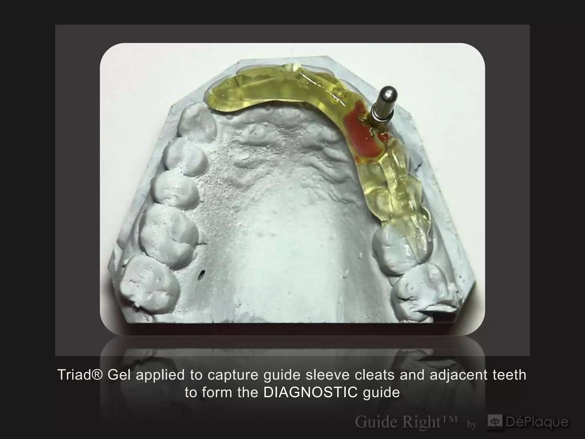 Triad® Gel applied to capture guide sleeve cleats and adjacent teeth
                  to form the DIAGNOSTIC guide
 