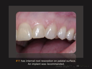 #11 has internal root resorption on palatal surface.
          An implant was recommended.
 