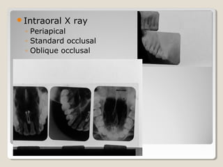 Maxillary Sinus | PPT