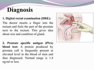 Benign Prostate Hypertrophy | PPTX
