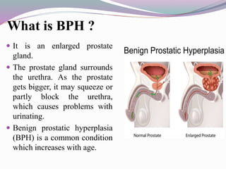 What is BPH ?
 It is an enlarged prostate
gland.
 The prostate gland surrounds
the urethra. As the prostate
gets bigger,...