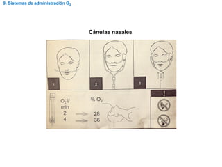 9. Sistemas de administración O2
Cánulas nasales
 