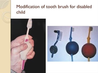 Modification of tooth brush for disabled
child
 