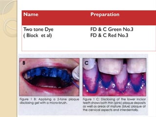 Name Preparation
Two tone Dye
( Block et al)
FD & C Green No.3
FD & C Red No.3
 