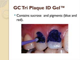 GCTri Plaque ID Gel™
 Contains sucrose and pigments (blue and
red).
 