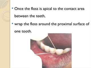  Once the floss is apical to the contact area
between the teeth,
 wrap the floss around the proximal surface of
one tooth.
 