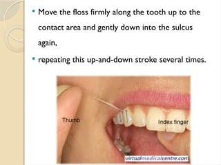  Move the floss firmly along the tooth up to the
contact area and gently down into the sulcus
again,
 repeating this up-and-down stroke several times.
 
