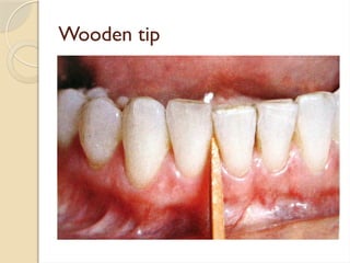 Wooden tip
 