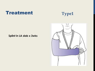 Treatment
Splint in LA slab x 3wks
Type1
 