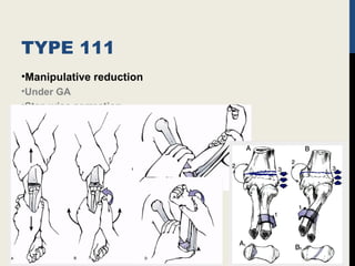 TYPE 111
•Manipulative reduction
•Under GA
•Step wise correction
 