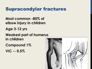 Supracondylar fractures
Most common -80% of
elbow injury in children
Age 3-12 yrs
Weakest part of humerus
in children
Compound 1%
VIC -- 0.5%
 