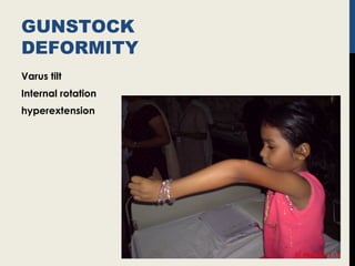 GUNSTOCK
DEFORMITY
Varus tilt
Internal rotation
hyperextension
 