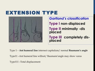 EXTENSION TYPE
Gartland’s classification
Type I non-displaced
Type II minimally -dis
placed
Type III completely dis-
placed
Type 1 – Ant humeral line intersect capitulum/ normal Baumann’s angle
Type11 –Ant humeral line willnot/ Baumann’angle may show varus
Type111 –Total displacement
 