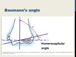Baumann’s angle
Humerocapitular
angle
 