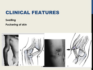 CLINICAL FEATURES
Swelling
Puckering of skin
 
