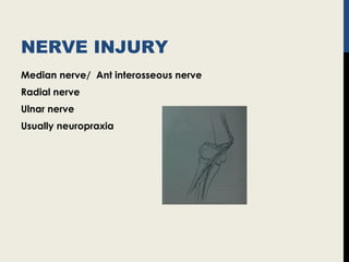 NERVE INJURY
Median nerve/ Ant interosseous nerve
Radial nerve
Ulnar nerve
Usually neuropraxia
 
