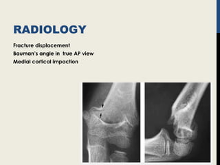 RADIOLOGY
Fracture displacement
Bauman’s angle in true AP view
Medial cortical impaction
 