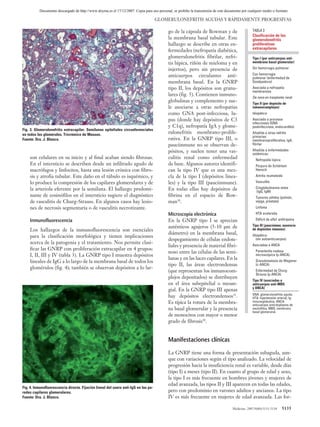 02 ACT80 (7-14).qxp         1/6/07       10:15      Página 5135




                 Documento descargado de http://www.doyma.es el 17/12/2007. Copia para uso personal, se prohíbe la transmisión de este documento por cualquier medio o formato.

                                                                                            GLOMERULONEFRITIS AGUDAS Y RÁPIDAMENTE PROGRESIVAS

                                                                                                  go de la cápsula de Bowman y de                       TABLA 3
                                                                                                                                                        Clasificación de las
                                                                                                  la membrana basal tubular. Este                       glomerulonefritis
                                                                                                  hallazgo se describe en otras en-                     proliferativas
                                                                                                                                                        extracapilares
                                                                                                  fermedades (nefropatía diabética,
                                                                                                  glomerulonefritis fibrilar, nefri-                    Tipo I (por anticuerpos anti-
                                                                                                  tis lúpica, riñón de mieloma y en                     membrana basal glomerular)

                                                                                                  injertos), pero sin presencia de                      Sin hemorragia pulmonar

                                                                                                  anticuerpos circulantes anti-                         Con hemorragia
                                                                                                                                                        pulmonar (enfermedad de
                                                                                                  membrana basal. En la GNRP                            Goodpasture)
                                                                                                  tipo II, los depósitos son granu-                     Asociada a nefropatía
                                                                                                                                                        membranosa
                                                                                                  lares (fig. 5). Contienen inmuno-
                                                                                                                                                        De novo en trasplante renal
                                                                                                  globulinas y complemento y sue-                       Tipo II (por depósito de
                                                                                                  le asociarse a otras nefropatías                      inmunocomplejos)
                                                                                                  como GNA post-infecciosa, lu-                         Idiopática
                                                                                                  pus (donde hay depósitos de C3                        Asociada a procesos
                                                                                                                                                        infecciosos (GNA
                                                                                                  y C1q), nefropatía IgA y glome-                       postinfecciosa, endocarditis)
       Fig. 3. Glomerulonefritis extracapilar. Semilunas epiteliales circunferenciales
       en todos los glomérulos. Tricrómico de Masson.                                             rulonefritis membrano-prolife-                        Añadida a otras nefritis
                                                                                                                                                        primarias:
       Fuente: Dra. J. Blanco.                                                                    rativa. En la GNRP tipo III, o                        membranoproliferativa, IgA,
                                                                                                  pauciinmune no se observan de-                        fibrilar
                                                                                                  pósitos, y suelen tener una vas-                      Añadida a enfermedades
                                                                                                                                                        sistémicas:
           son celulares en su inicio y al final acaban siendo fibrosas.                          culitis renal como enfermedad                           Nefropatía lúpica
           En el intersticio se describen desde un infiltrado agudo de                            de base. Algunos autores identifi-                      Púrpura de Schönlein
           macrófagos y linfocitos, hasta una lesión crónica con fibro-                           can la tipo IV que es una mez-                          Henoch
           sis y atrofia tubular. Este daño en el túbulo es isquémico, y                          cla de la tipo I (depósitos linea-                      Artritis reumatoide
           lo produce la compresión de los capilares glomerulares y de                            les) y la tipo III (pauciinmune).                       Vasculitis

           la arteriola eferente por la semiluna. El hallazgo predomi-                            En todas ellas hay depósitos de                         Crioglobulinemia mixta
                                                                                                                                                          (IgG, IgM)
           nante de eosinófilos en el intersticio sugiere el diagnóstico                          fibrina en el espacio de Bow-                           Tumores sólidos (pulmón,
           de vasculitis de Churg-Strauss. En algunos casos hay lesio-                            man30.                                                  vejiga, próstata)
           nes de necrosis segmentaria o de vasculitis necrotizante.                                                                                      Linfoma
                                                                                                  Microscopia electrónica                                 HTA acelerada
           Inmunofluorescencia                                                                    En la GNRP tipo I se aprecian                           Déficit de alfa1 antitripsina

                                                                                                  auténticos agujeros (5-10 µm de                       Tipo III (paucinmue, ausencia
           Los hallazgos de la inmunofluorescencia son esenciales                                                                                       de depósitos inmunes)
                                                                                                  diámetro) en la membrana basal,                       Idiopática
           para la clasificación morfológica y tienen implicaciones
                                                                                                  despegamiento de células endote-                        (sin autoanticuerpos)
           acerca de la patogenia y el tratamiento. Nos permite clasi-
                                                                                                  liales y presencia de material fibri-                 Asociadas a ANCA
           ficar las GNRP con proliferación extracapilar en 4 grupos:                                                                                     Panarteritis nodosa
                                                                                                  noso entre las células de las semi-
           I, II, III y IV (tabla 3). La GNRP tipo I muestra depósitos                                                                                    microscópica (p-ANCA)
                                                                                                  lunas y en las luces capilares. En la
           lineales de IgG a lo largo de la membrana basal de todos los                                                                                   Granulomatosis de Wegener
                                                                                                  tipo II, las áreas electrondensas                       (c-ANCA)
           glomérulos (fig. 4); también se observan depósitos a lo lar-
                                                                                                  (que representan los inmunocom-                         Enfermedad de Churg-
                                                                                                                                                          Strauss (p-ANCA)
                                                                                                  plejos depositados) se distribuyen
                                                                                                                                                        Tipo IV (asociadas a
                                                                                                  en el área subepitelial o mesan-                      anticuerpos anti-MBG
                                                                                                                                                        y ANCA)
                                                                                                  gial. En la GNRP tipo III apenas
                                                                                                                                                        GNA: glomerulonefritis aguda;
                                                                                                  hay depósitos electrondensos31.                       HTA: hipertensión arterial; Ig:
                                                                                                  Es típica la rotura de la membra-                     inmunoglobulina; ANCA:
                                                                                                                                                        anticuerpos anticitoplasma de
                                                                                                  na basal glomerular y la presencia                    neutrófilos; MBG: membrana
                                                                                                                                                        basal glomerunal.
                                                                                                  de monocitos con mayor o menor
                                                                                                  grado de fibrosis30.


                                                                                                  Manifestaciones clínicas
                                                                                                  La GNRP tiene una forma de presentación subaguda, aun-
                                                                                                  que con variaciones según el tipo analizado. La velocidad de
                                                                                                  progresión hacia la insuficiencia renal es variable, desde días
                                                                                                  (tipo I) a meses (tipo II). En cuanto al grupo de edad y sexo,
                                                                                                  la tipo I es más frecuente en hombres jóvenes y mujeres de
                                                                                                  edad avanzada, las tipos II y III aparecen en todas las edades,
       Fig. 4. Inmunofluorescencia directa. Fijación lineal del suero anti-IgG en las pa-
       redes capilares glomerulares.                                                              pero con predominio en varones adultos y ancianos. La tipo
       Fuente: Dra. J. Blanco.                                                                    IV es más frecuente en mujeres de edad avanzada. Las for-

                                                                                                                                           Medicine. 2007;9(80):5131-5138     5135
 