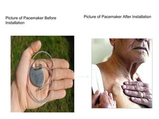 Picture of Pacemaker After InstallationPicture of Pacemaker Before
Installation