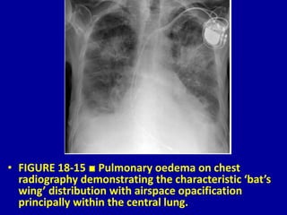18 Airspace Diseases Dr. Muhammad Bin Zulfiqar | PPTX