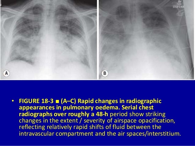 Lower Lobe Airspace Disease - Captions More
