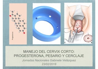 MANEJO DEL CERVIX CORTO:
PROGESTERONA, PESARIO Y CERCLAJE
Jornadas Nacionales Gabinete Velázquez
23/02/2018
 