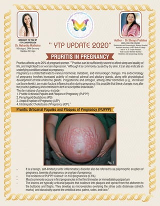 PRURITIS IN PREGNANCY
“ YTP UPDATE 2020”
Author - Dr Shreya Prabhoo
MBBS, DGO, DNB, MNAMS
Obstetrician and Gynaecologist, Mukund Hospital
Assistant Honorary at HBT Medical College
and Dr. R. N. Cooper Hospital
Youth Council Member Mumbai
Obstetrics and Gynaecology Society
Dr. Neharika Malhotra
MD(obgyn), DRM Germany
Rainbow IVF, Agra
BROUGHT TO YOU BY
YTP CHAIRPERSON
1,2
Pruritus affects up to 20% of pregnant women. Pruritus can be sufficiently severe to affect sleep and quality of
3
life, and might lead to or worsen depression. Although it is commonly caused by dry skin, it can also indicate an
underlyingconditionunique topregnancy.
Pregnancy is a state that leads to various hormonal, metabolic, and immunologic changes. The endocrinology
of pregnancy involves increased activity of maternal adrenal and pituitary glands, along with physiological
development of fetal endocrine glands. Progesterone and estrogen, among other hormones (e.g., increased
cortisone levels), are major factors influencing skin during pregnancy. It is possible that these changes may alter
4
theprurituspathwayandcontribute toitchinsusceptibleindividuals.
Thedermatosesofpregnancyinclude
1.Pruritic UrticarialPapulesandPlaquesofPregnancy(PUPPP)
2.Pemphigoid Gestationis(PG)
3.AtopicEruptionofPregnancy(AEP)
5
4.Intrahepatic CholestasisofPregnancy(ICP).
Pruritic Urticarial Papules and Plaques of Pregnancy (PUPPP)
- It is a benign, self-limited pruritic inflammatory disorder also be referred to as polymorphic eruption of
pregnancy,toxemiaofpregnancy,orprurigoofpregnancy.
- Theincidence ofPUPPPisabout1in160pregnancies(0.6%)
- Mostcommonlyoccursinfirstpregnanciesinthethirdtrimesterorimmediatelypostpartum
- The lesions are typically urticarial papules that coalesce into plaques and spread from the abdomen to
the buttocks and thighs. They develop as microvesicles overlying the striae cutis distensae (stretch
6
marks) andclassicallysparestheumbilicalarea,palms,soles,andface.
Fig. 1
 