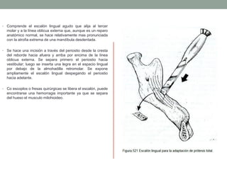 • Comprende el escalón lingual agudo que alija al tercer
molar y a la línea oblicua externa que, aunque es un reparo
anatómico normal, se hace relativamente mas pronunciada
con la atrofia extrema de una mandíbula desdentada.
• Se hace una incisión a través del periostio desde la cresta
del reborde hacia afuera y arriba por encima de la línea
oblicua externa. Se separa primero el periostio hacia
vestibular; luego se inserta una legra en el espacio lingual
por debajo de la almohadilla retromolar. Se expone
ampliamente el escalón lingual despegando el periostio
hacia adelante.
• Co escoplos o fresas quirúrgicas se libera el escalón, puede
encontrarse una hemorragia importante ya que se separa
del hueso el musculo milohioideo.
 