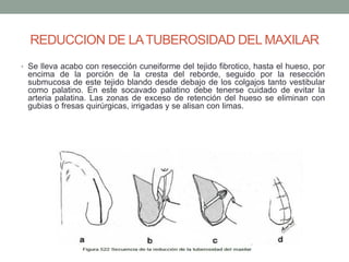 REDUCCION DE LATUBEROSIDAD DEL MAXILAR
• Se lleva acabo con resección cuneiforme del tejido fibrotico, hasta el hueso, por
encima de la porción de la cresta del reborde, seguido por la resección
submucosa de este tejido blando desde debajo de los colgajos tanto vestibular
como palatino. En este socavado palatino debe tenerse cuidado de evitar la
arteria palatina. Las zonas de exceso de retención del hueso se eliminan con
gubias o fresas quirúrgicas, irrigadas y se alisan con limas.
 