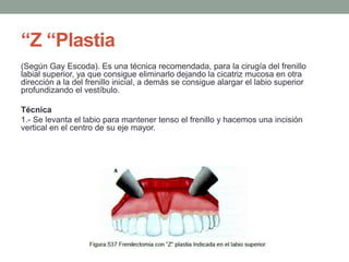 “Z “Plastia
(Según Gay Escoda). Es una técnica recomendada, para la cirugía del frenillo
labial superior, ya que consigue eliminarlo dejando la cicatriz mucosa en otra
dirección a la del frenillo inicial, a demás se consigue alargar el labio superior
profundizando el vestíbulo.
Técnica
1.- Se levanta el labio para mantener tenso el frenillo y hacemos una incisión
vertical en el centro de su eje mayor.
 