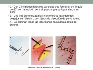 • 2.- Con 2 incisiones laterales paralelas que formaran un ángulo
de 60º con la incisión central, puesto que se logra alargar un
75%
• 3.- Una vez profundizada las incisiones se levantan dos
colgajos con bisturí o con tijeras de disección de punta roma.
• 4.- Se eliminan todas las inserciones musculares antes de
suturar.
 