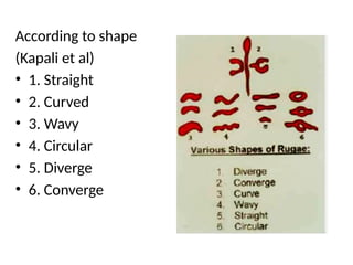 According to shape
(Kapali et al)
• 1. Straight
• 2. Curved
• 3. Wavy
• 4. Circular
• 5. Diverge
• 6. Converge
 