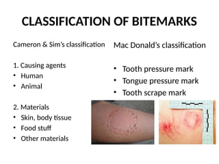 CLASSIFICATION OF BITEMARKS
Cameron & Sim’s classification
1. Causing agents
• Human
• Animal
2. Materials
• Skin, body tissue
• Food stuff
• Other materials
Mac Donald’s classification
• Tooth pressure mark
• Tongue pressure mark
• Tooth scrape mark
 