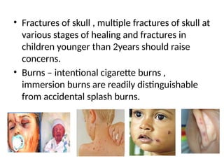 • Fractures of skull , multiple fractures of skull at
various stages of healing and fractures in
children younger than 2years should raise
concerns.
• Burns – intentional cigarette burns ,
immersion burns are readily distinguishable
from accidental splash burns.
 