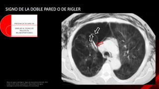 Comprehensive Overview of Pleural Diseases and Diagnostic Imaging | PPTX