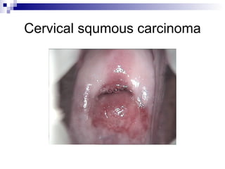 Cervical squmous carcinoma 