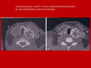18 Dr Ahmed Esawy imaging oral board of larynx imaging