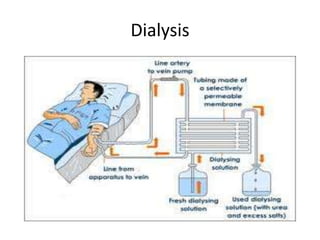 Dialysis
 