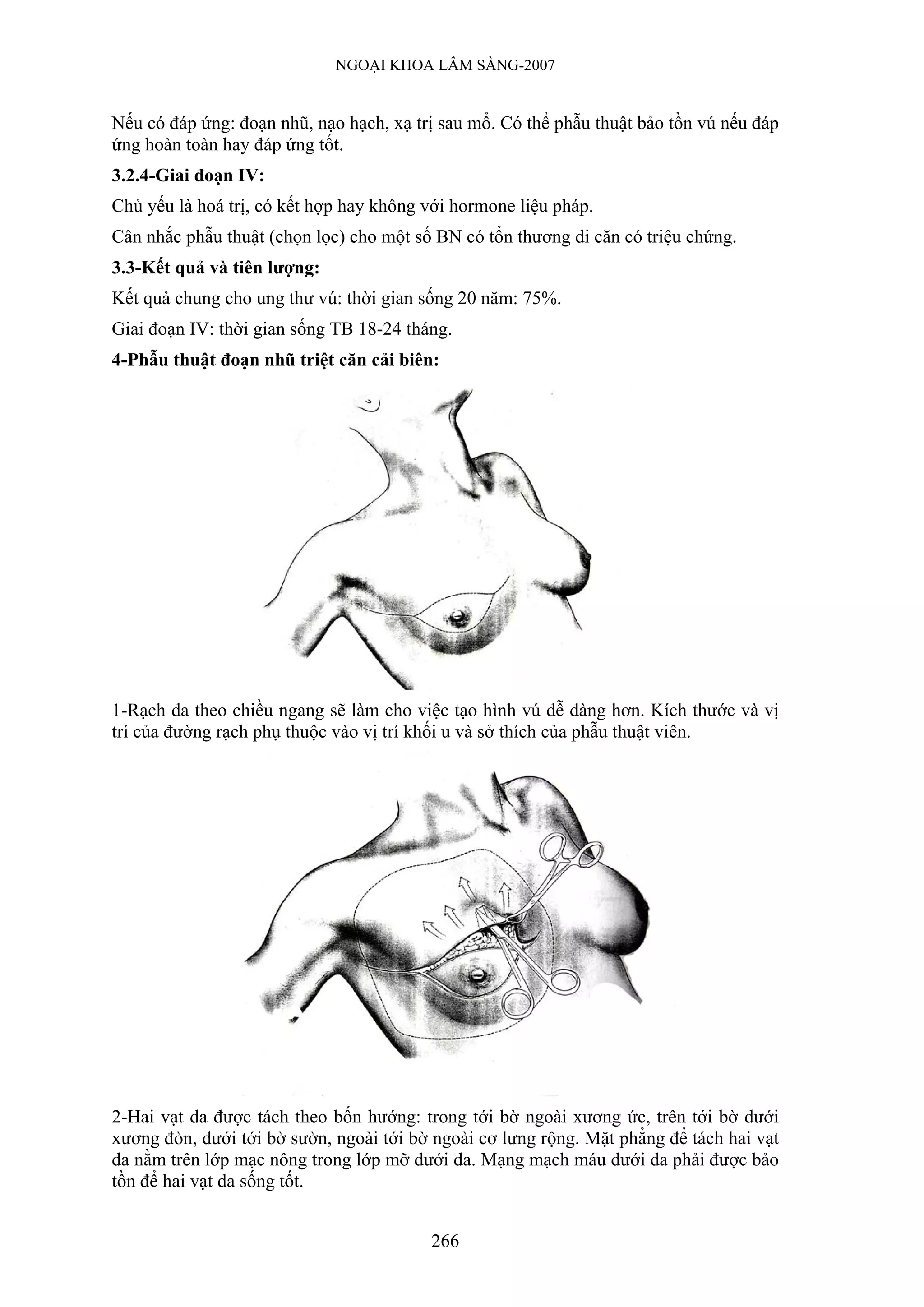 NGOẠI KHOA LÂM SÀNG-2007


Nếu có đáp ứng: đoạn nhũ, nạo hạch, xạ trị sau mổ. Có thể phẫu thuật bảo tồn vú nếu đáp
ứng hoàn toàn hay đáp ứng tốt.
3.2.4-Giai đoạn IV:
Chủ yếu là hoá trị, có kết hợp hay không với hormone liệu pháp.
Cân nhắc phẫu thuật (chọn lọc) cho một số BN có tổn thương di căn có triệu chứng.
3.3-Kết quả và tiên lượng:
Kết quả chung cho ung thư vú: thời gian sống 20 năm: 75%.
Giai đoạn IV: thời gian sống TB 18-24 tháng.
4-Phẫu thuật đoạn nhũ triệt căn cải biên:




1-Rạch da theo chiều ngang sẽ làm cho việc tạo hình vú dễ dàng hơn. Kích thước và vị
trí của đường rạch phụ thuộc vào vị trí khối u và sở thích của phẫu thuật viên.




2-Hai vạt da được tách theo bốn hướng: trong tới bờ ngoài xương ức, trên tới bờ dưới
xương đòn, dưới tới bờ sườn, ngoài tới bờ ngoài cơ lưng rộng. Mặt phẳng để tách hai vạt
da nằm trên lớp mạc nông trong lớp mỡ dưới da. Mạng mạch máu dưới da phải được bảo
tồn để hai vạt da sống tốt.


                                         266
 