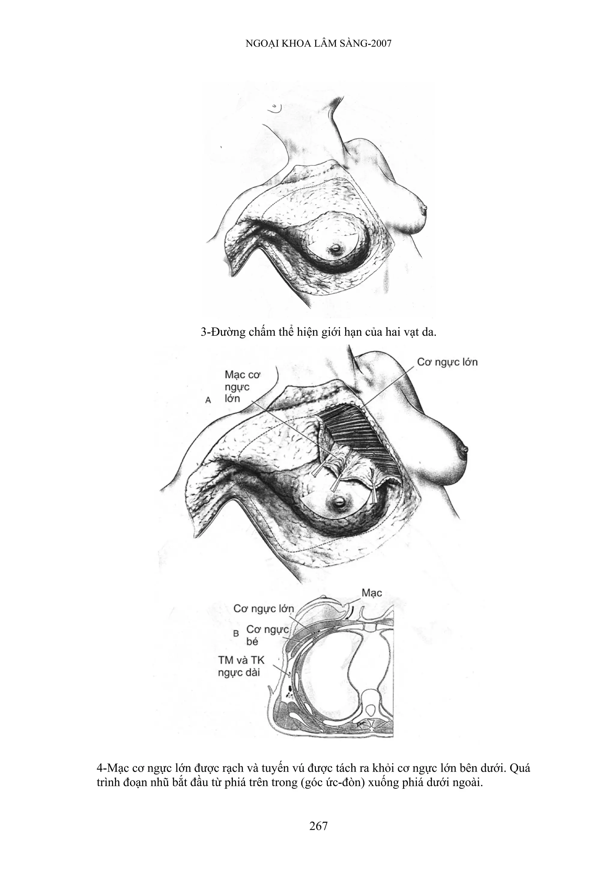 NGOẠI KHOA LÂM SÀNG-2007




                   3-Đường chấm thể hiện giới hạn của hai vạt da.




4-Mạc cơ ngực lớn được rạch và tuyến vú được tách ra khỏi cơ ngực lớn bên dưới. Quá
trình đoạn nhũ bắt đầu từ phiá trên trong (góc ức-đòn) xuống phiá dưới ngoài.


                                        267
 